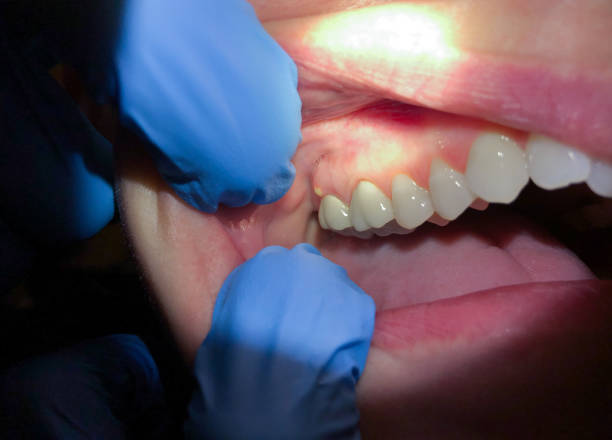 Best Emergency Tooth Extraction in High Ridge, MO